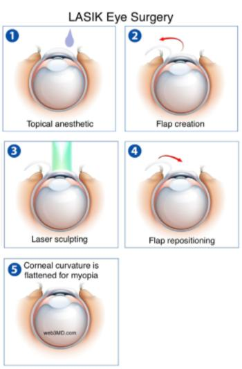 LASER Eye Surgery